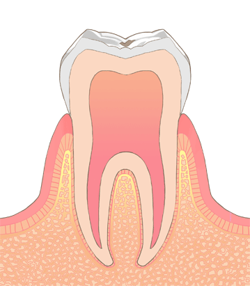 C0｜歯の脱灰