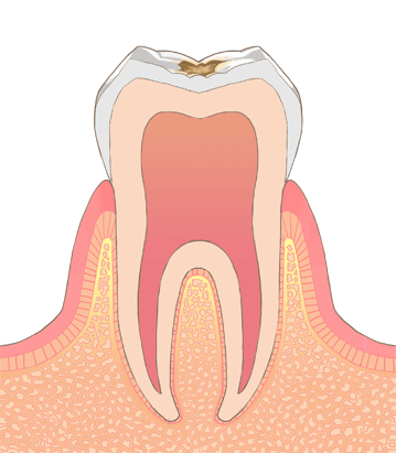 C1｜エナメル質まで虫歯が進行