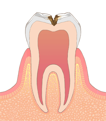 C2｜象牙質まで虫歯が進行