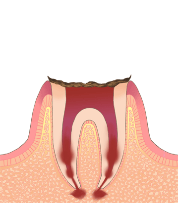 C4｜歯の根まで虫歯が進行